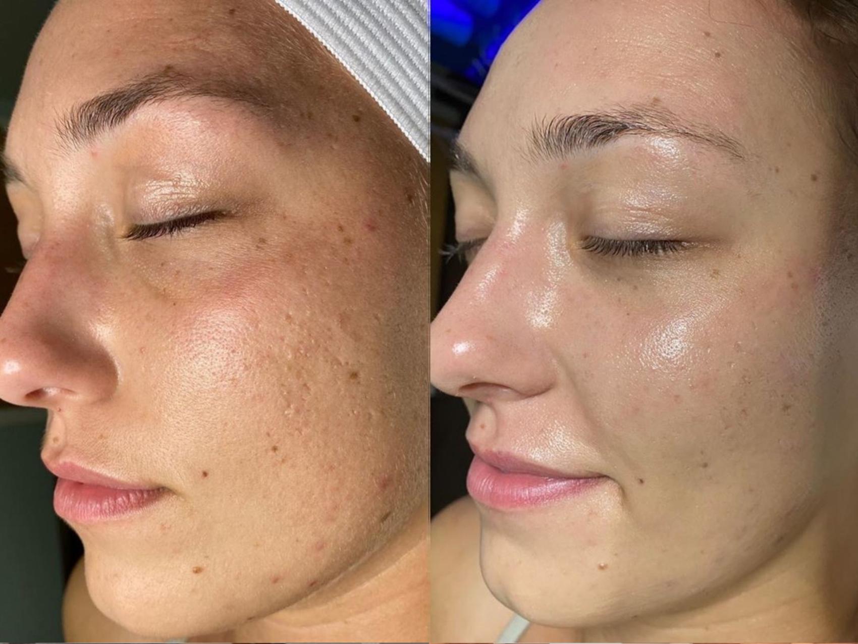 بشرة مشرقة ومتجددة في جلسة واحدة! HydraFacial